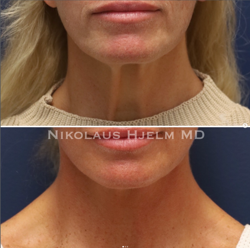 Neck Lift