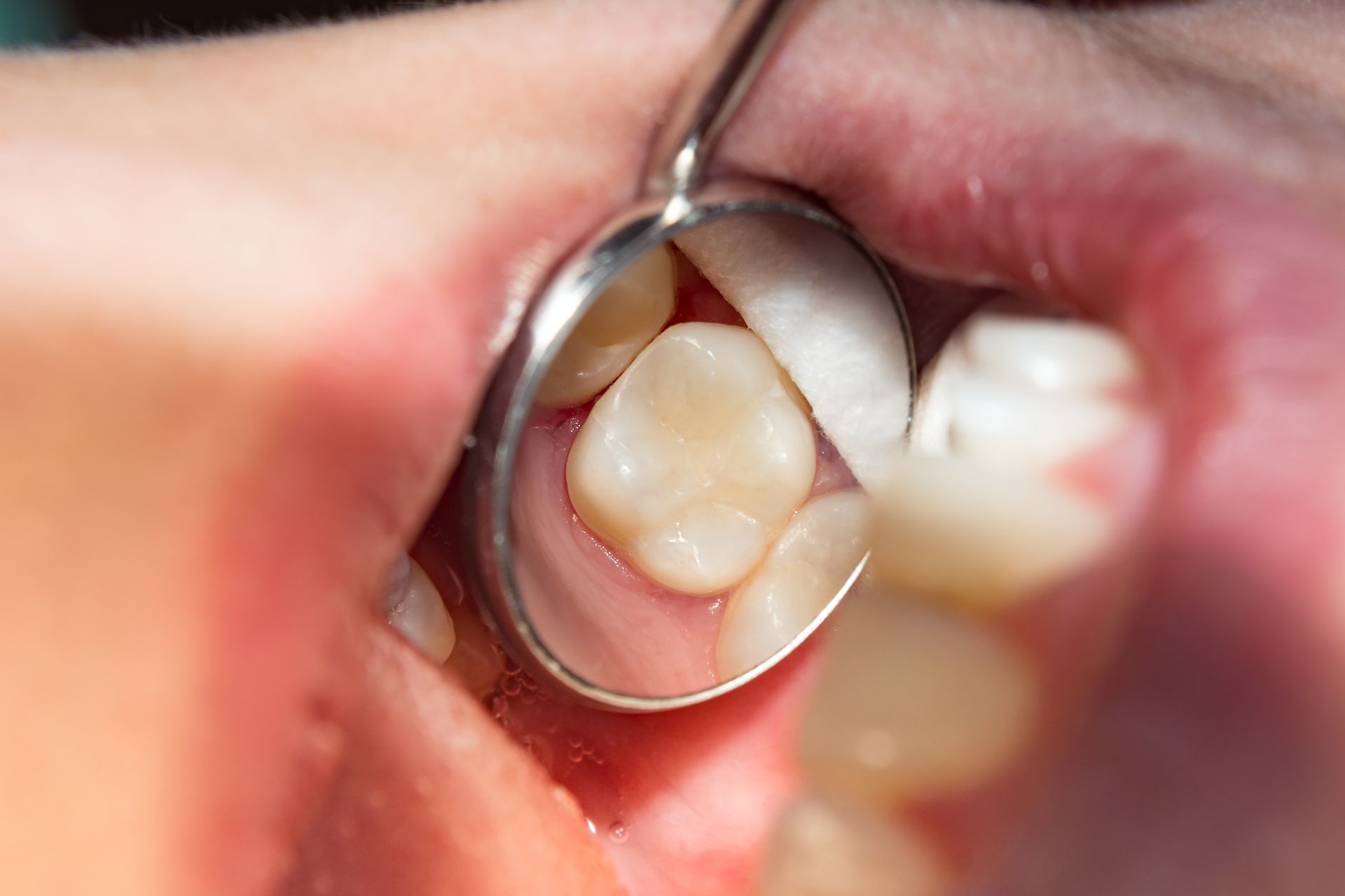 Close-up of molar teeth in a mouth, viewed with a dental mirror during an exam