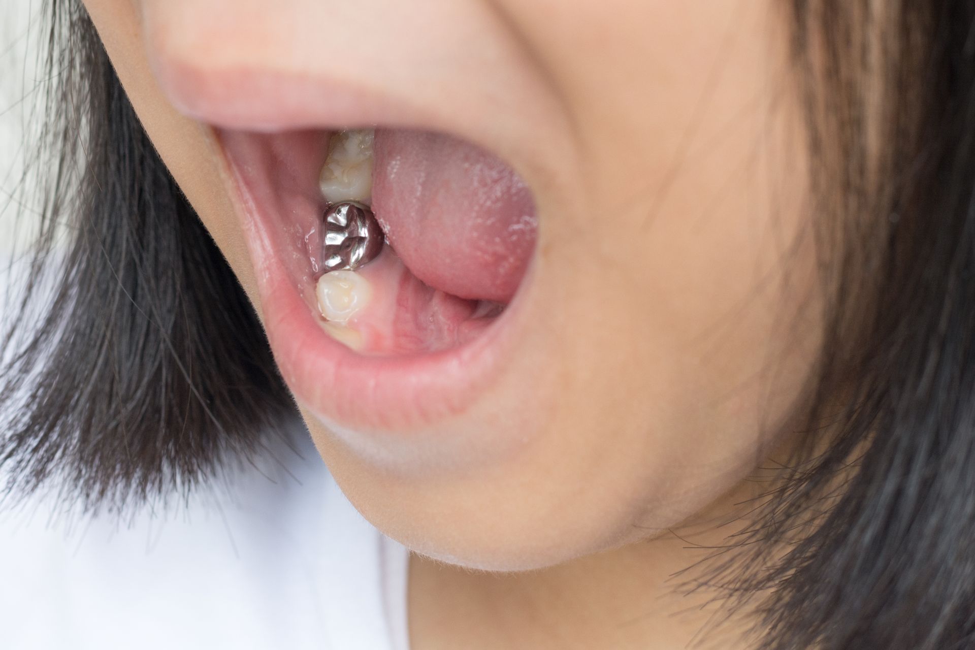 Close-up of an open mouth showing a metallic dental filling on a back tooth.
