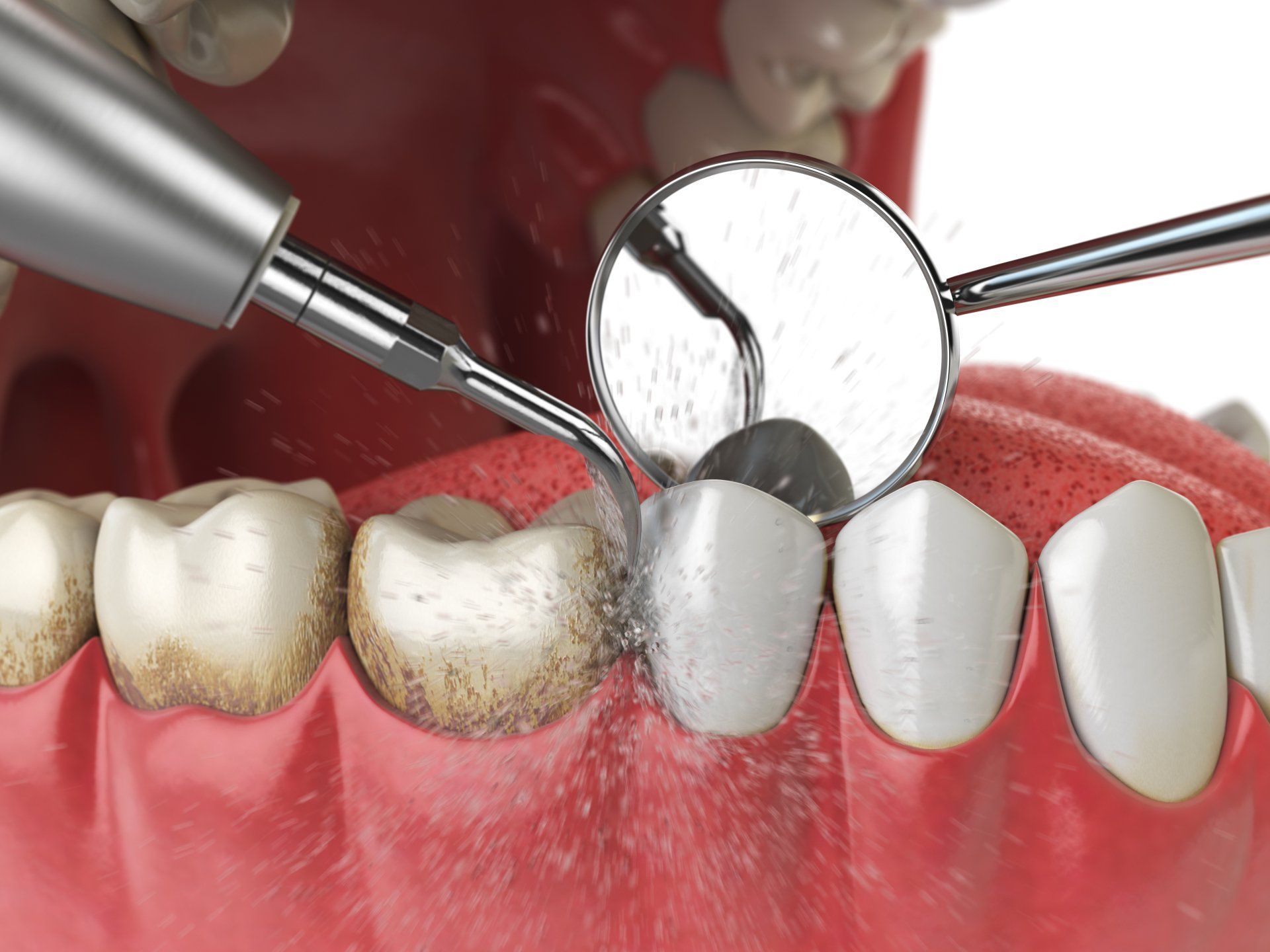 Dental drill polishing a front tooth during a dental procedure