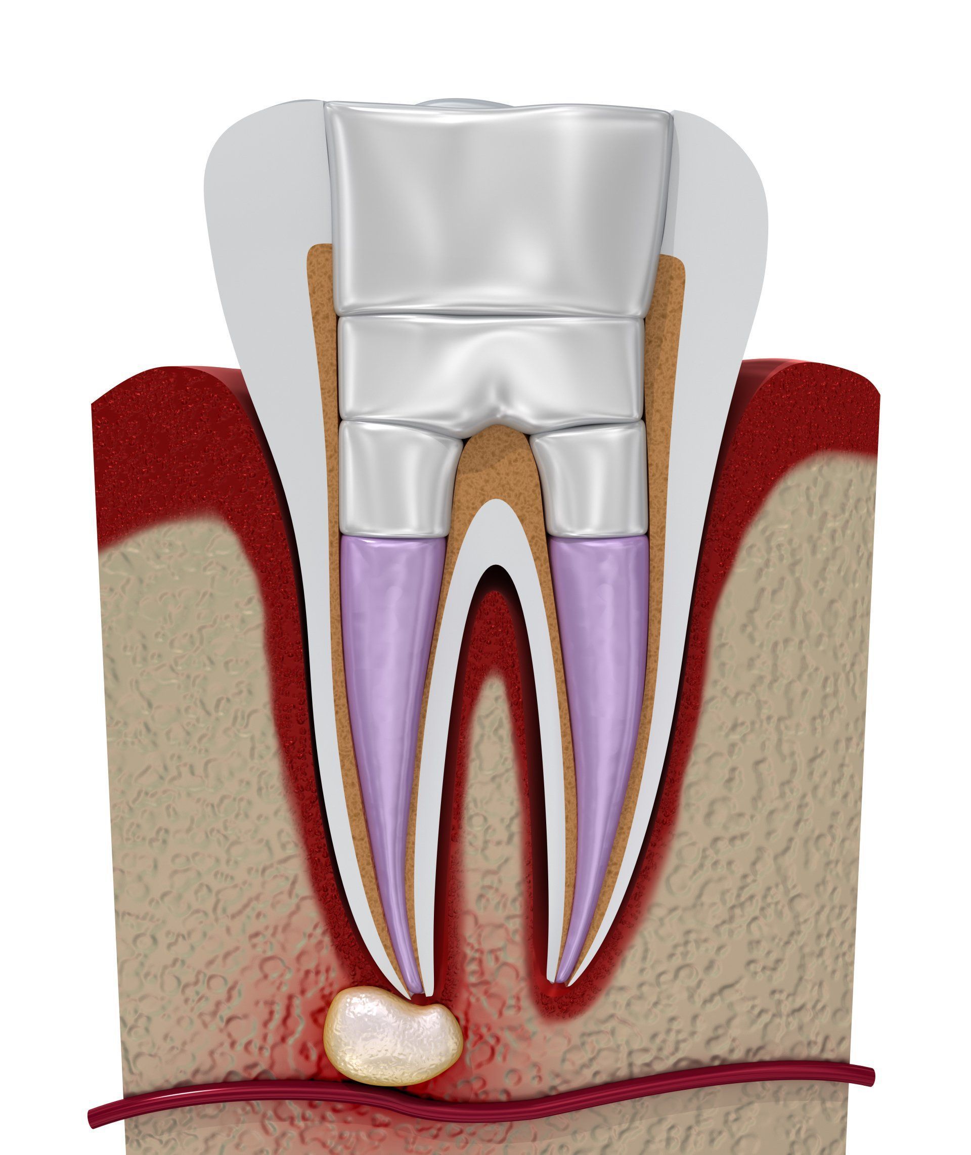 Cross-section of a tooth with a root canal procedure and an infected gum area at the root tip.