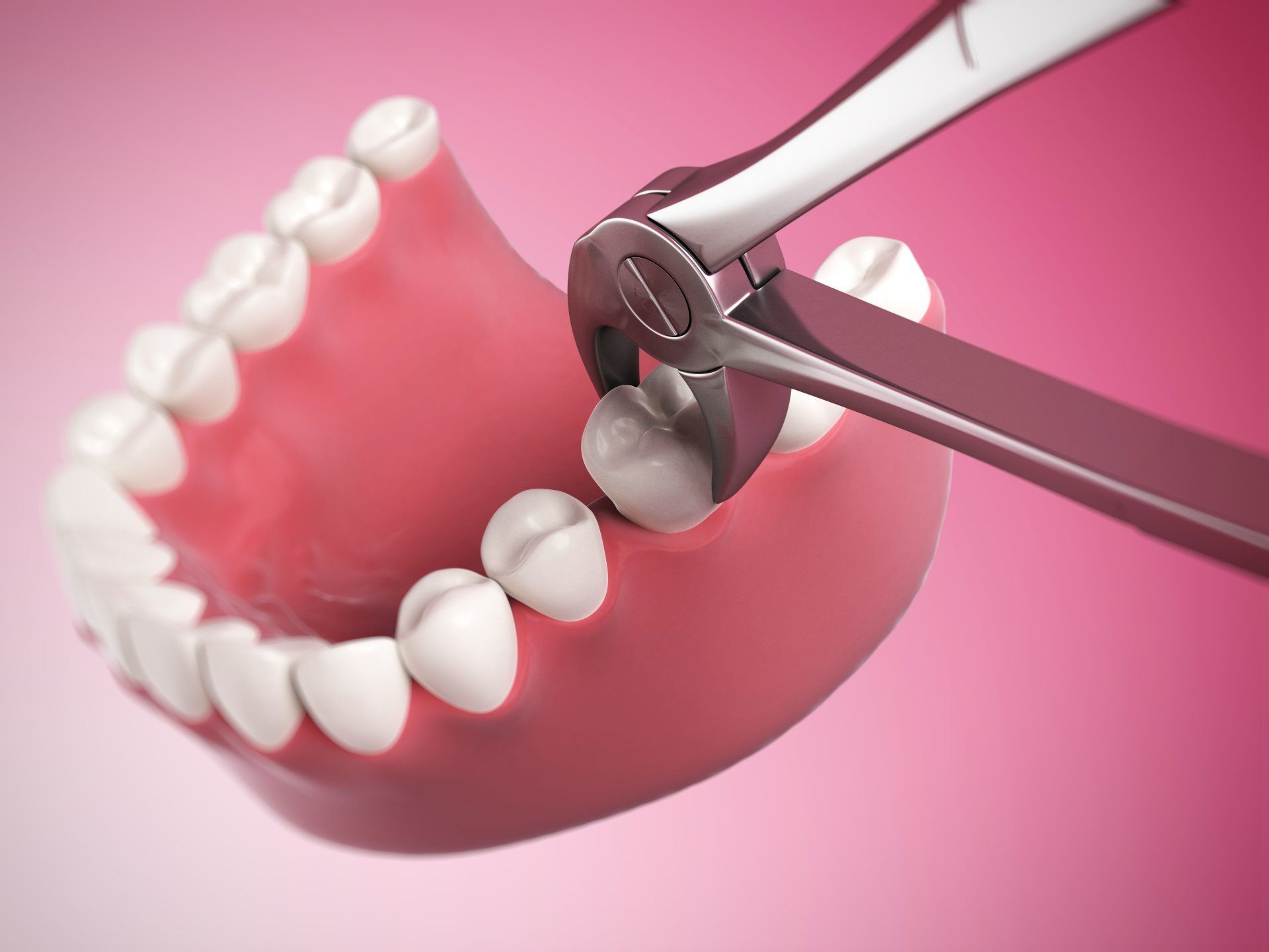 Dental tool extracting a tooth from a pink gum model