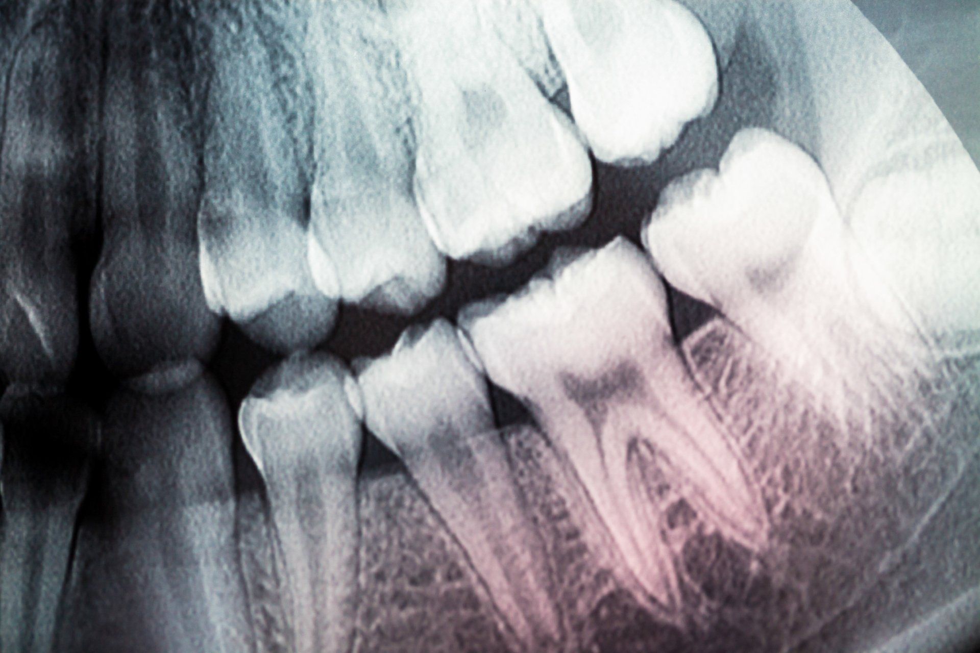 Close-up X-ray of teeth and jaw with visible dental roots and fillings