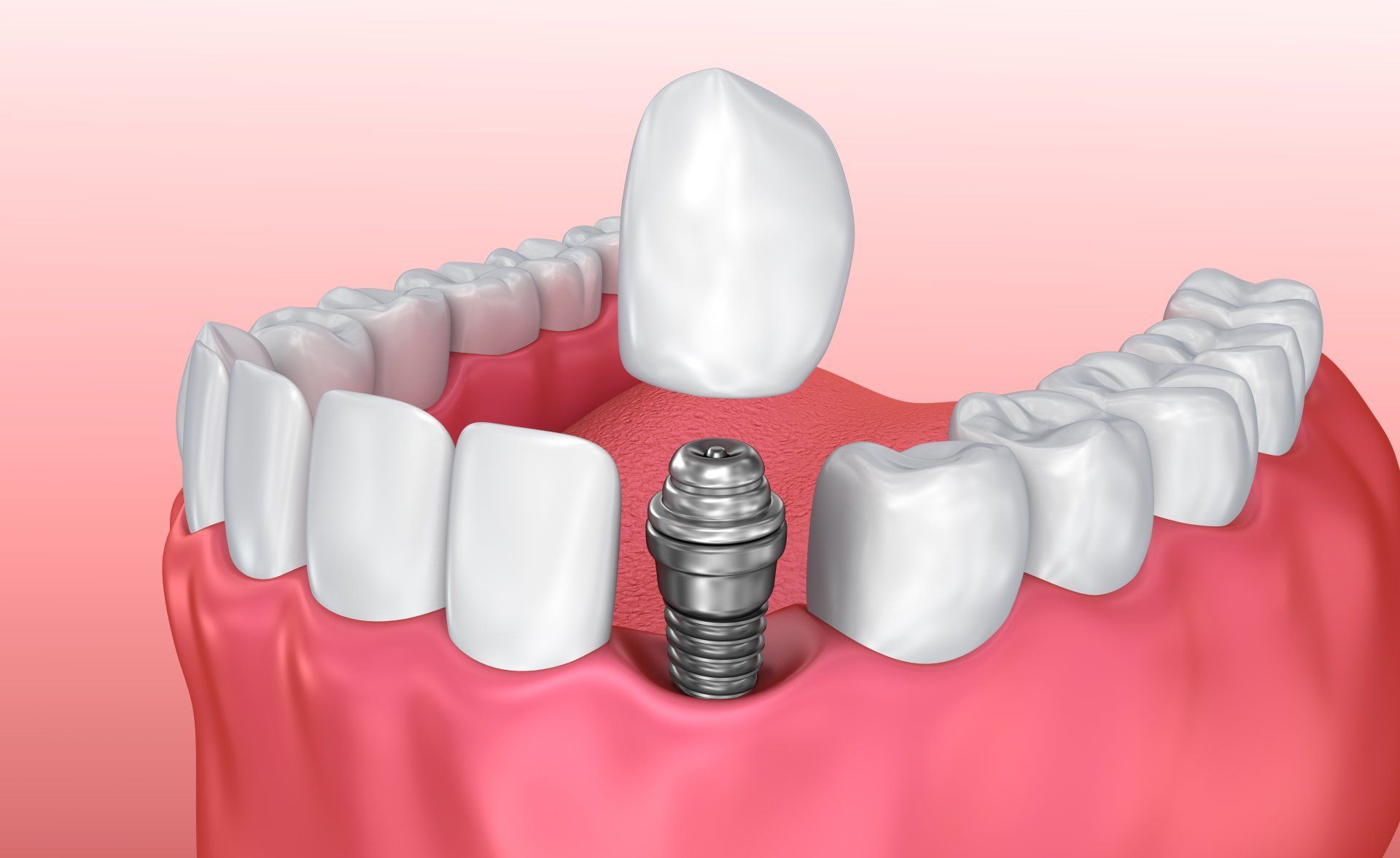 Upper and lower teeth with a dental implant post in the front center of the mouth