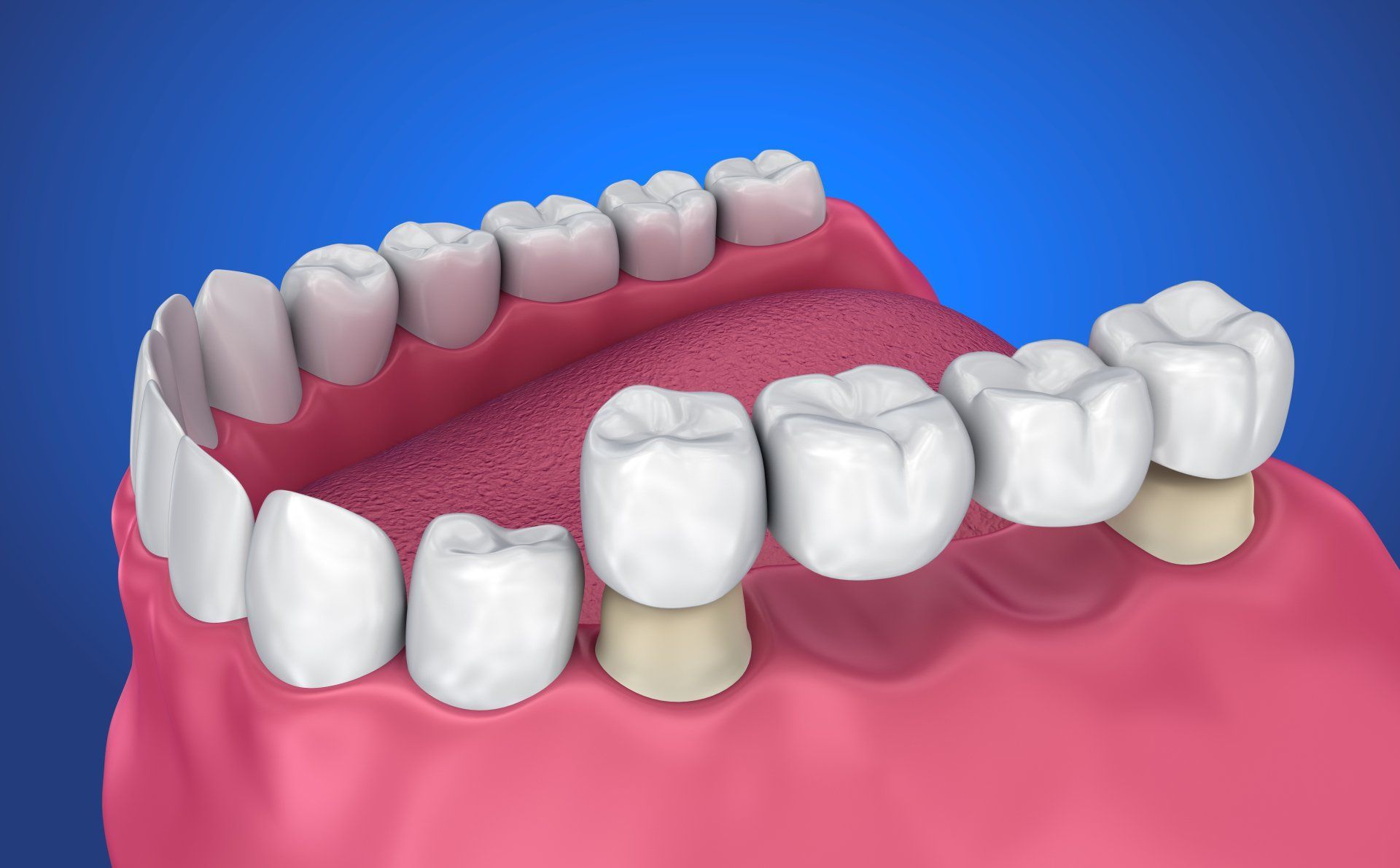 3D dental model showing a partial upper bridge on pink gums and teeth