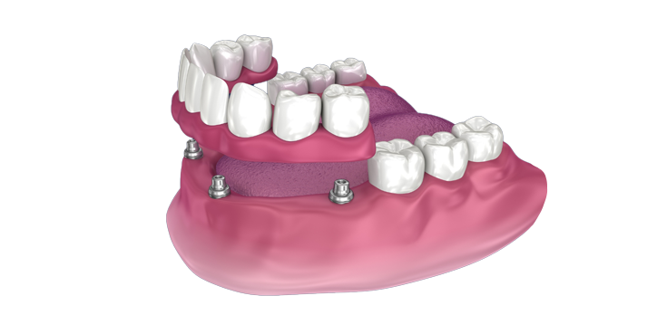 An illustration of a full denture with dental implants.