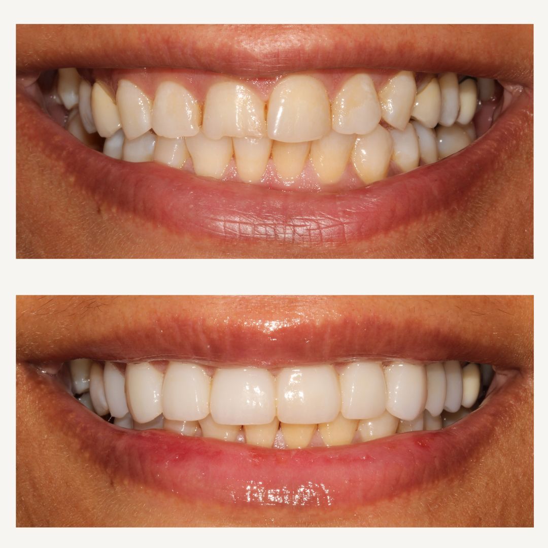 Orthodontics Before and After - Crown Point Dental