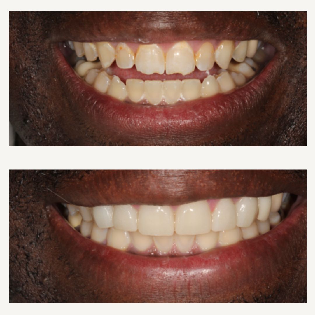 Orthodontics Before and After - Crown Point Dental