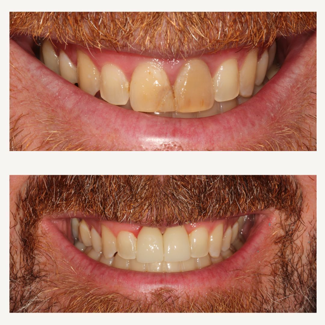 Crowns Before and After - Crown Point Dental
