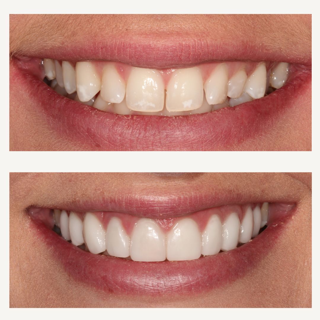 Orthodontics Before and After - Crown Point Dental