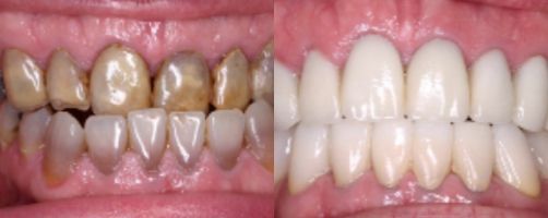 Before & After Photo