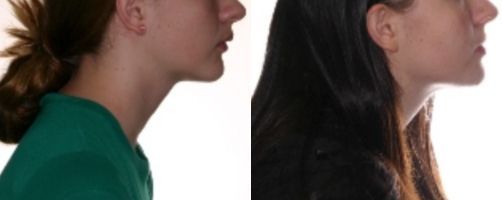 Before & After Photo