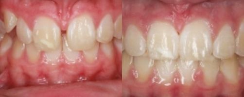 Before & After Photo