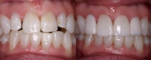 Before & After Photo