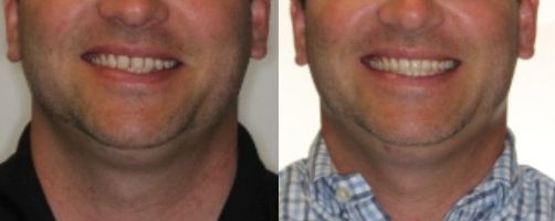 Before & After Photo