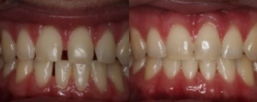 Before & After Photo