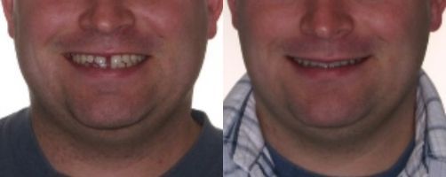 Before & After Photo