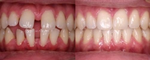 Before & After Photo