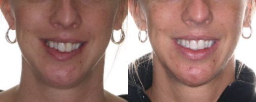 Before & After Photo