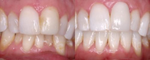 Before & After Photo