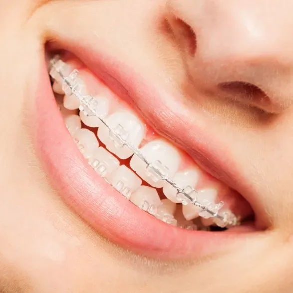 Closeup of clear braces