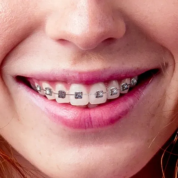 Closeup of metal braces