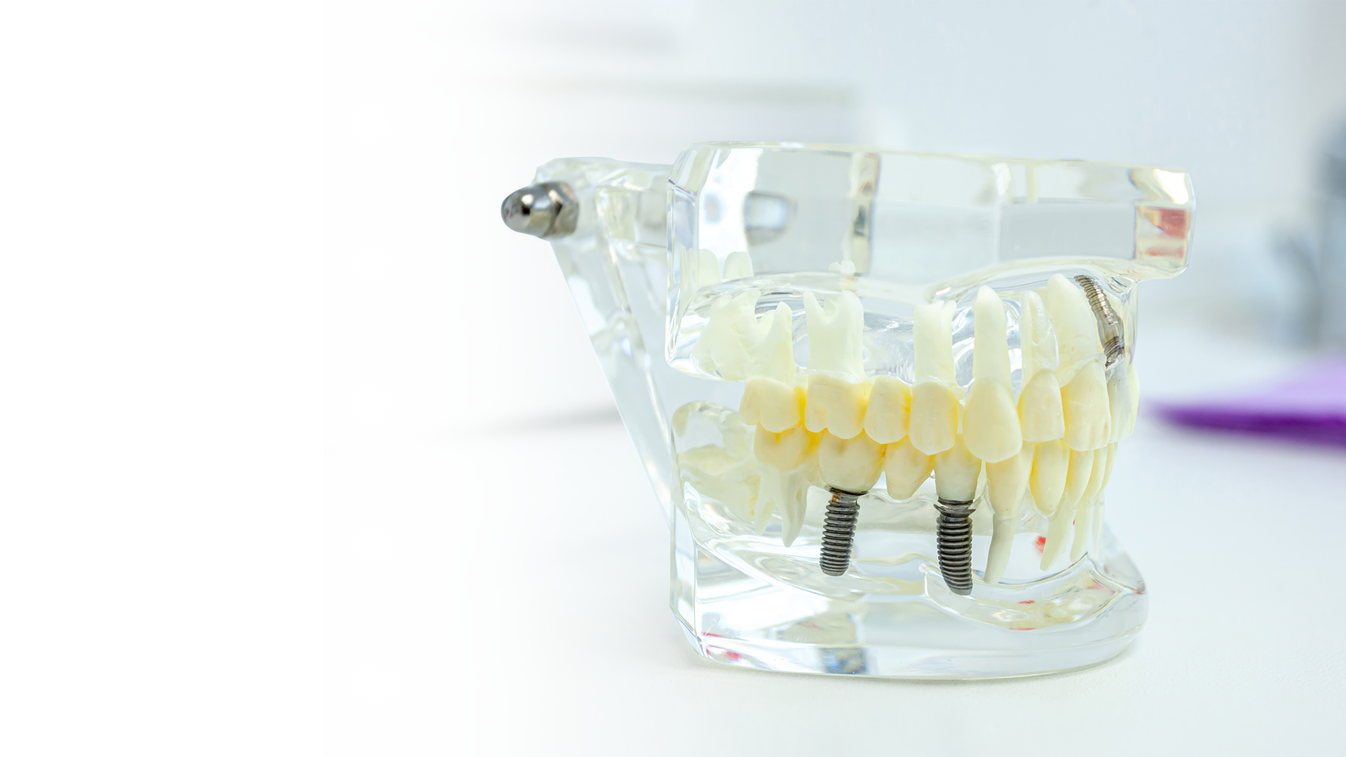 Transparent dental model with teeth and gums displayed on a white background