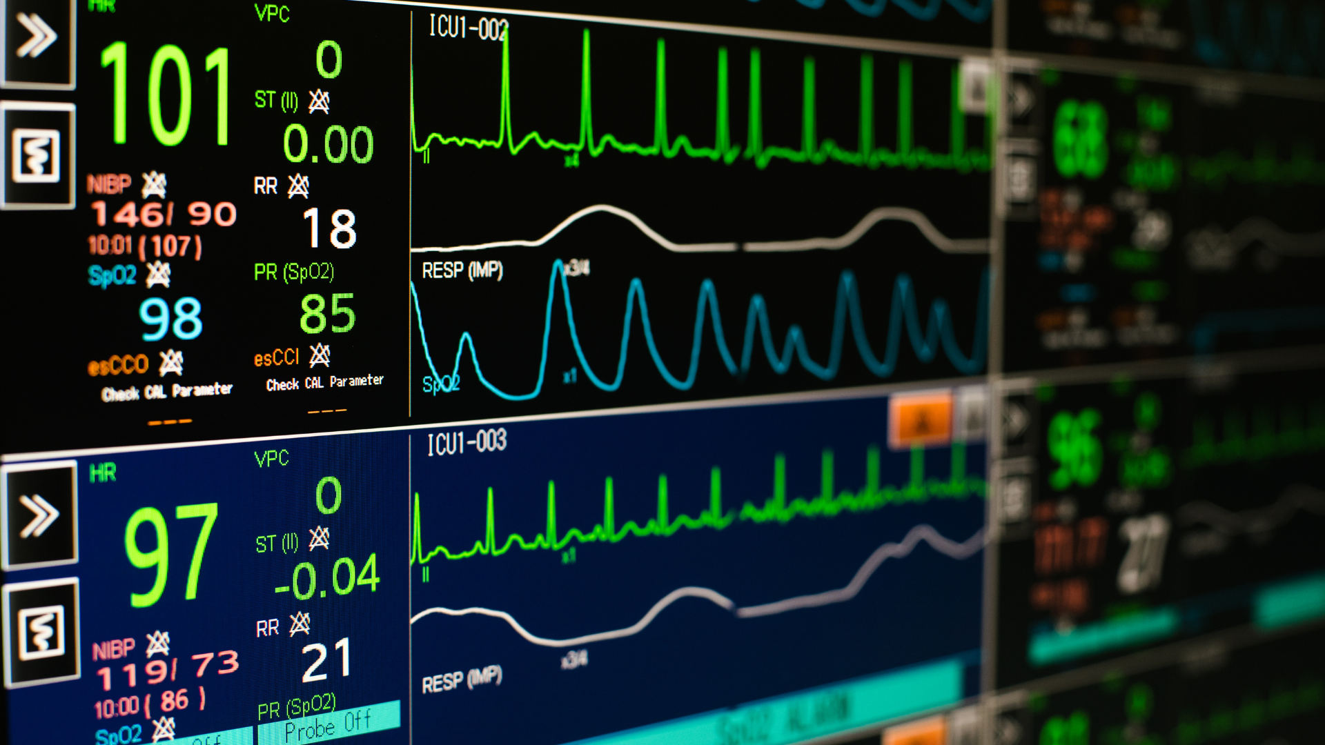 Medical monitors displaying vital signs and ECG waveforms.