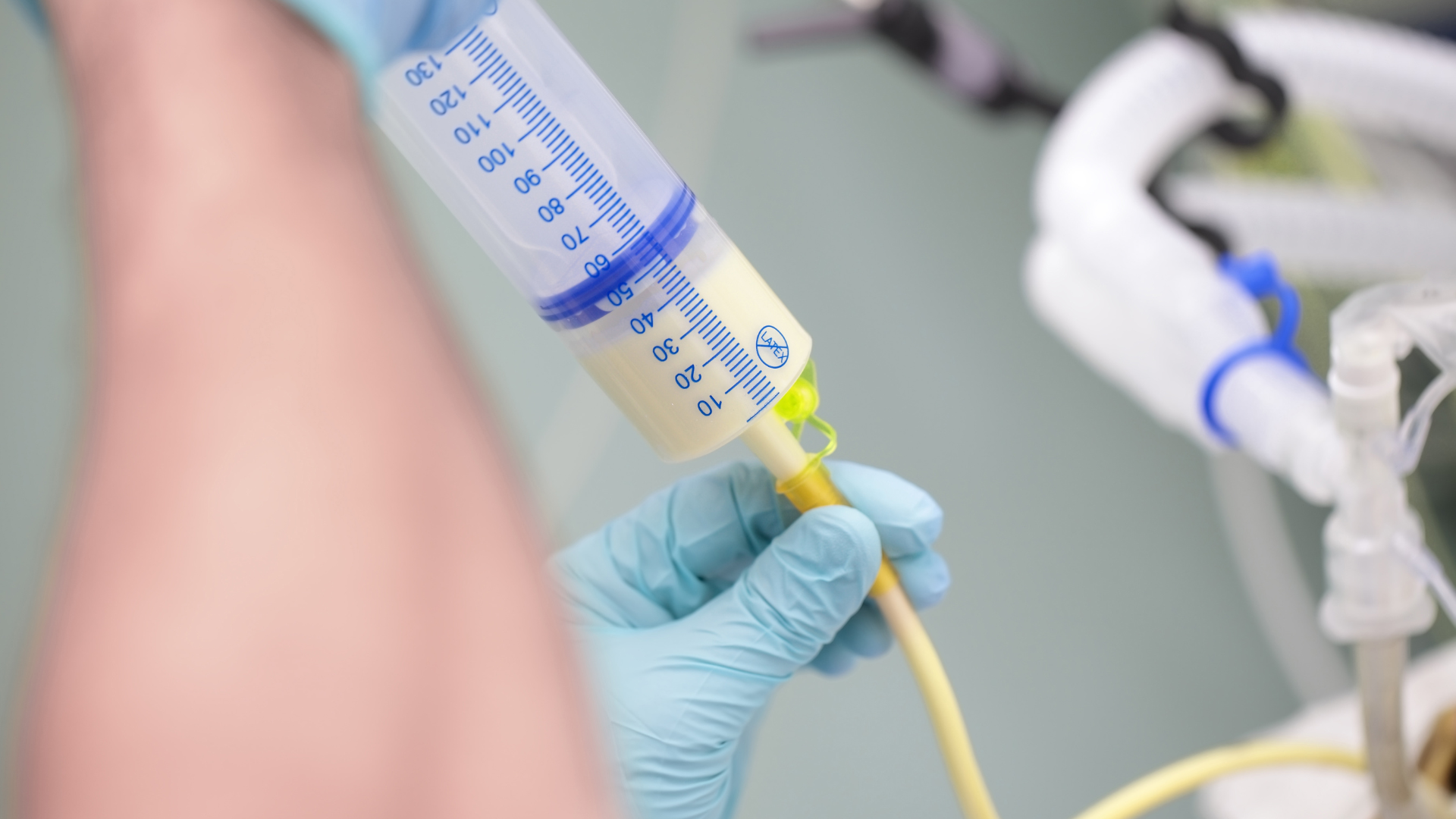 Gloved hand holding syringe filled with pale yellow liquid, connected to a feeding tube, in a medical setting.