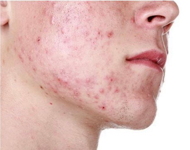 face full of acne and oily skin