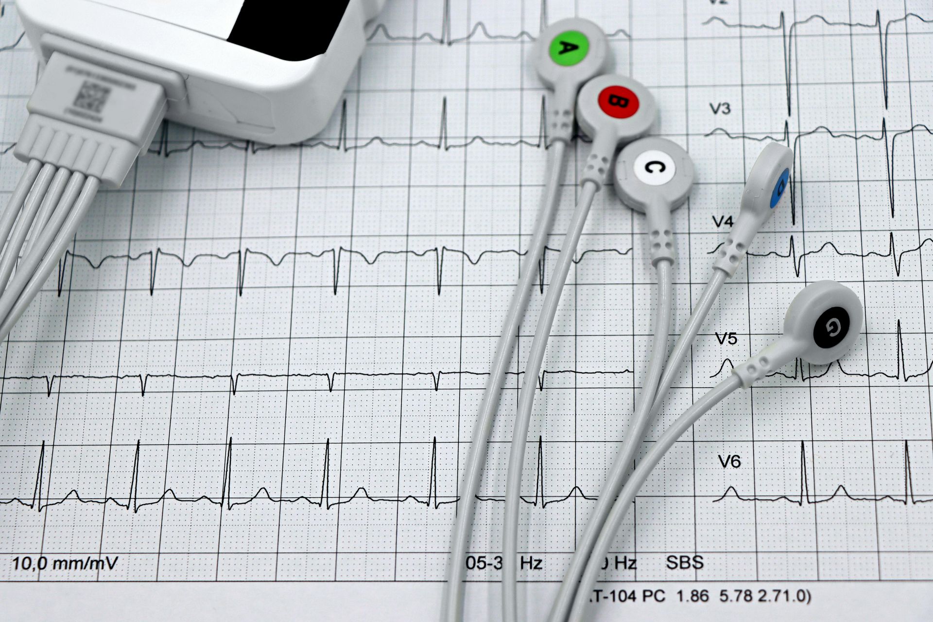 An ecg is shown on a piece of paper with a bunch of wires attached to it