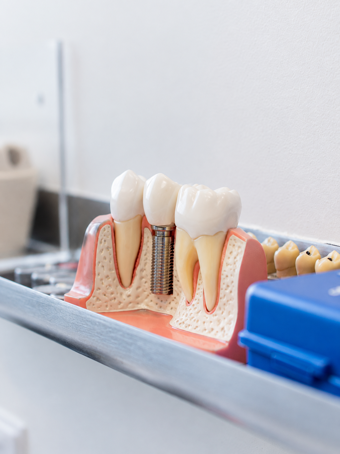 Dental model of teeth and gums with a visible implant, shown on a table with a blue tool nearby