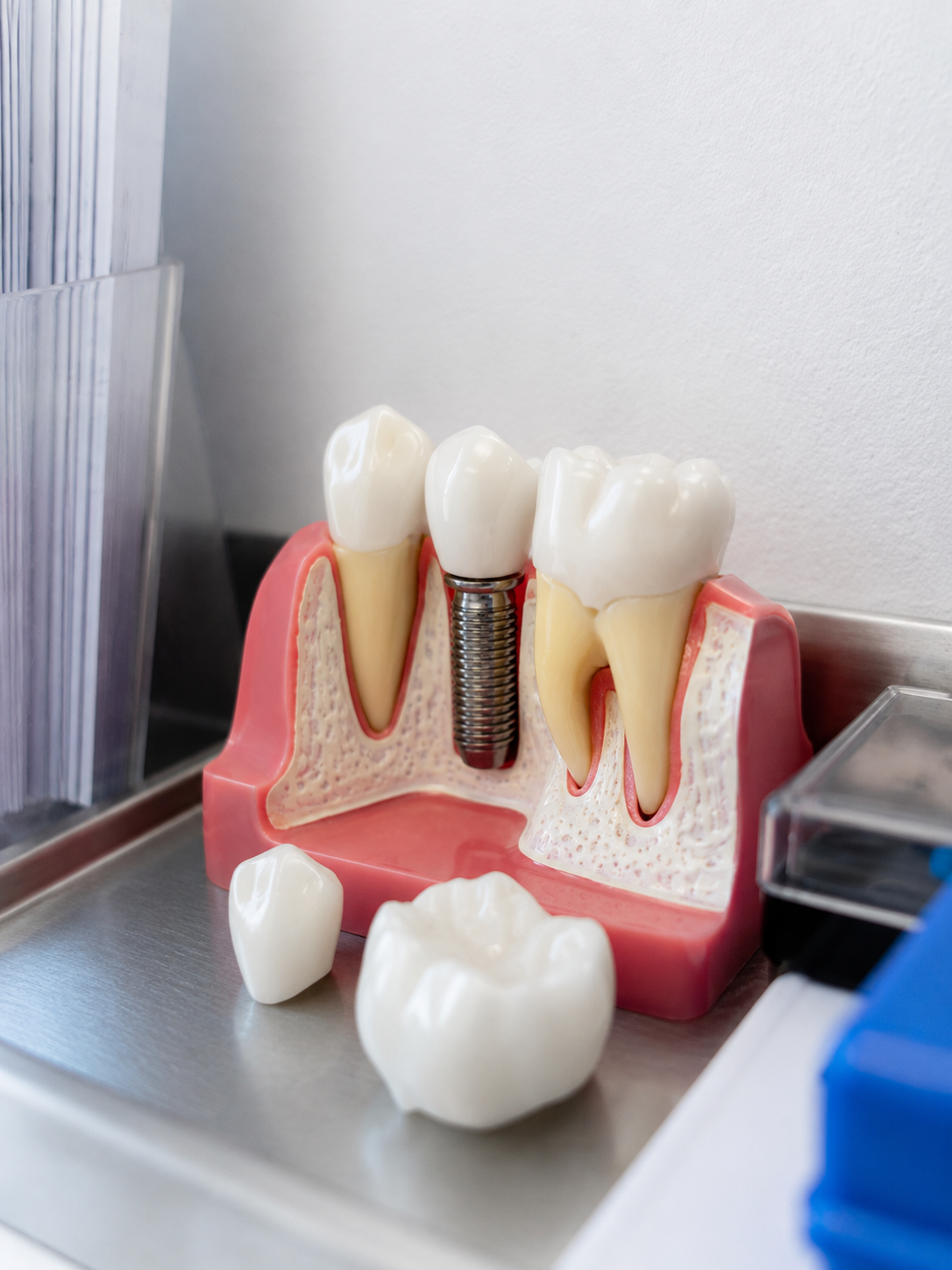 Dental implant model showing teeth and gums with a visible metal implant post