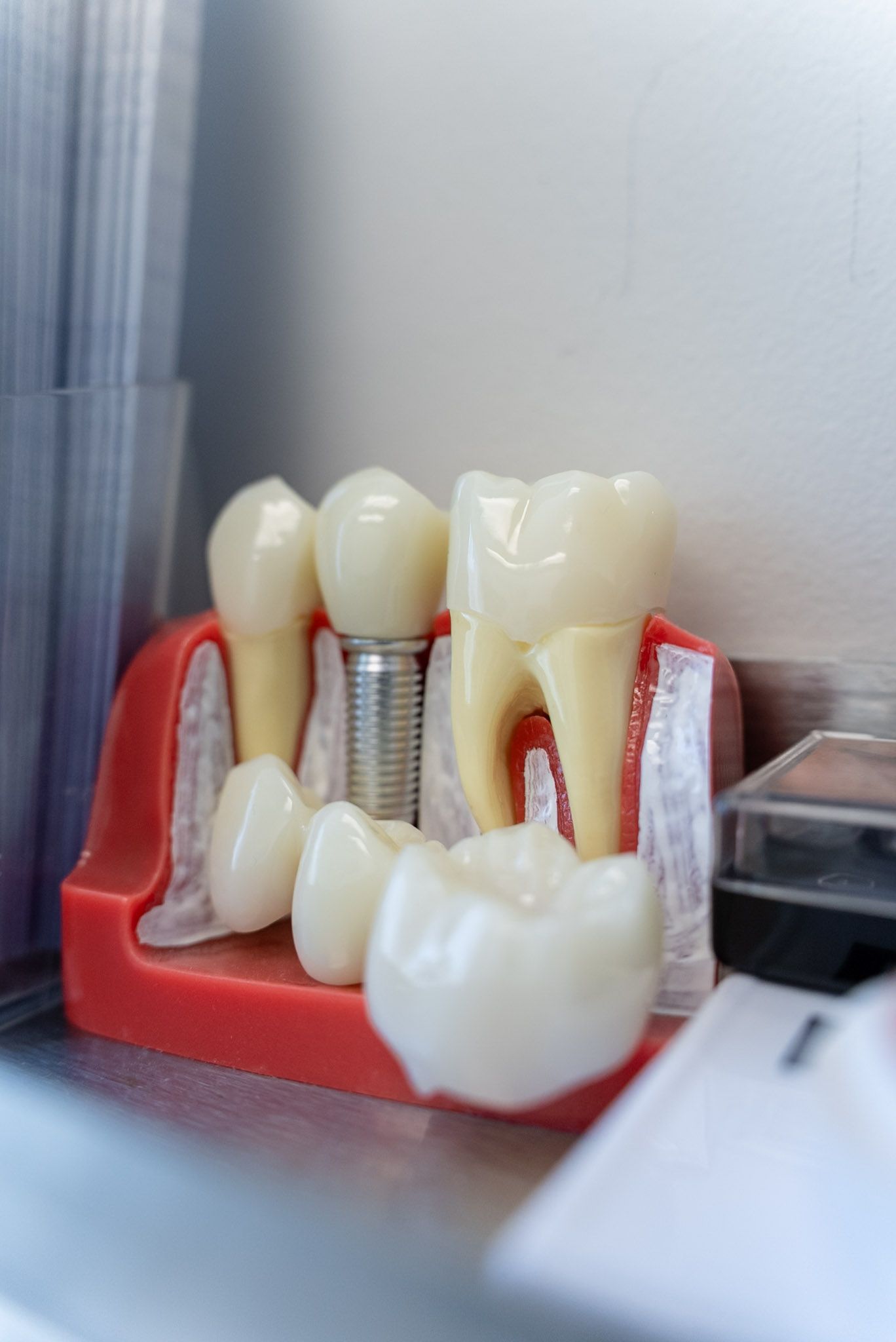 Implant, crown and bridge models used by a Los Angeles dentist to explain care