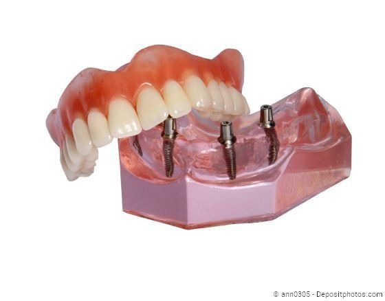 Mit Implantaten kann der Halt von schlecht sitzenden Prothesen erheblich verbessert werden.