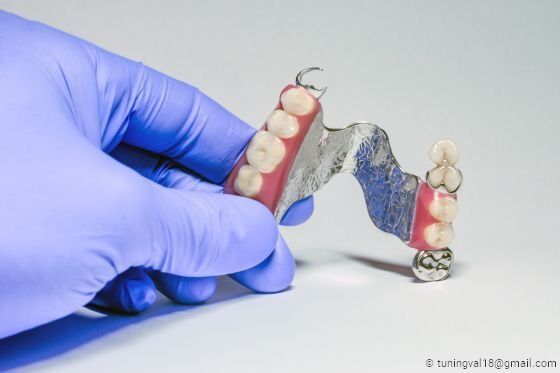 Mit Implantaten können herausnehmbare Teilprothesen oft vermieden werden.