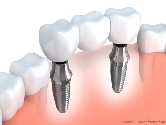 Für eine Brücke müssten oft gesunde Zähne abgeschliffen werden. Mit Implantaten kann man das vermeiden.