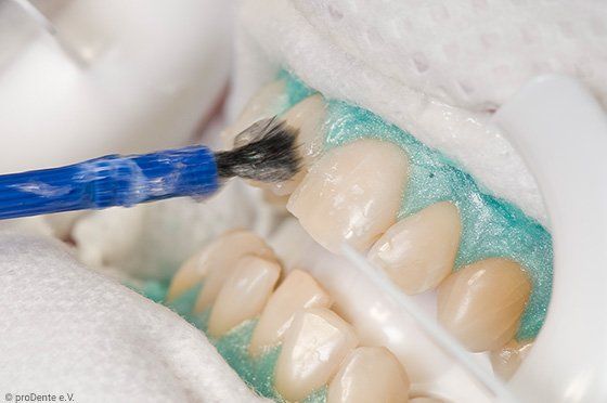 Weiße Zähne in ein bis zwei Stunden mit Power-Bleaching!