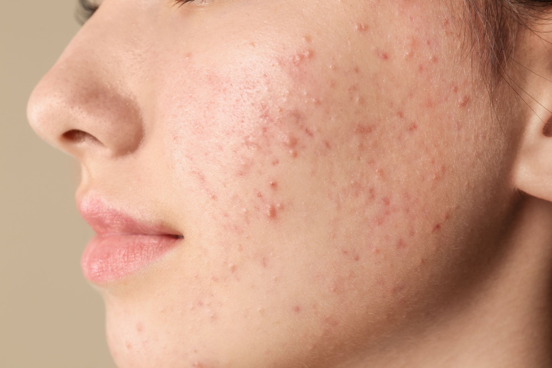 Acne on the Cheeks