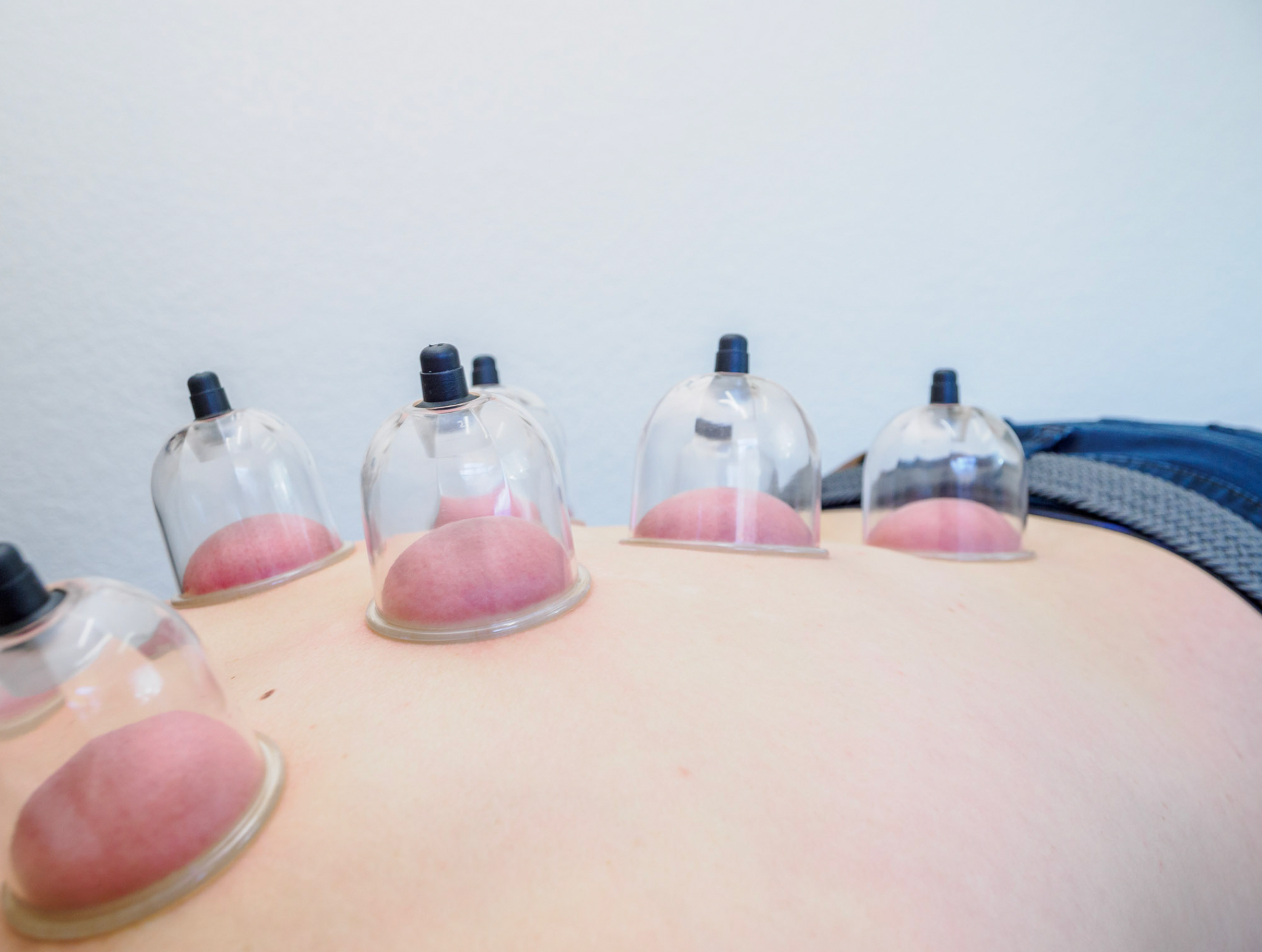 Cupping therapy treatment Resilience Chiropractic Sonoma County CA