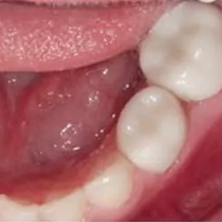 Close-up of an open mouth with tongue and molars visible, showing a red irritated area inside cheek