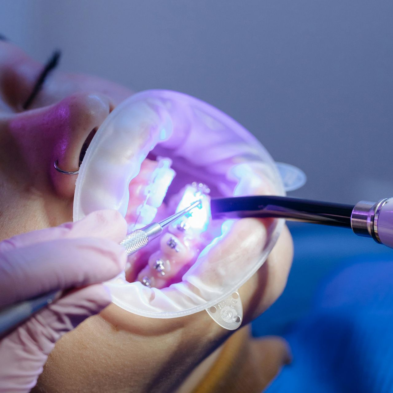 Dental procedure with blue light curing a tooth in a patient's open mouth