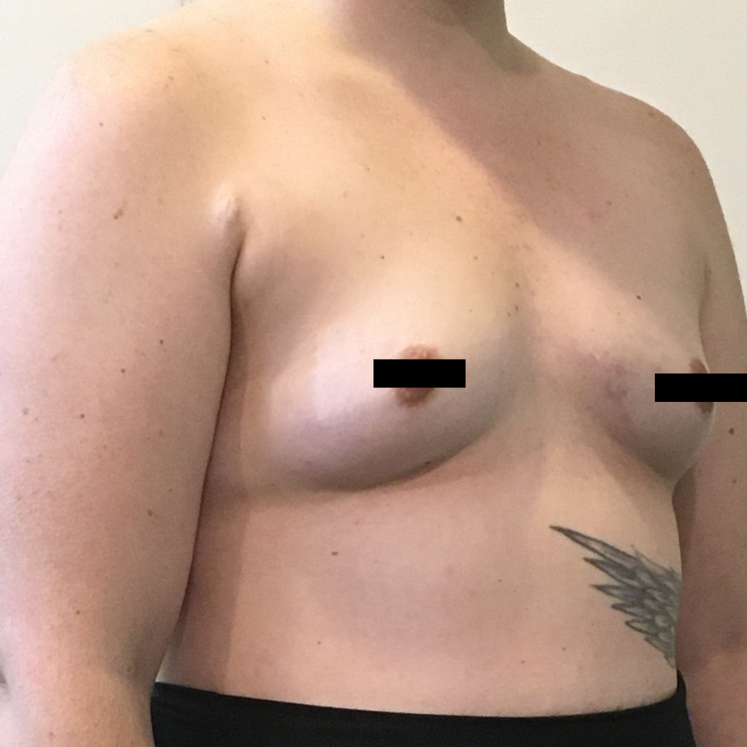 Breast Augmentation with Mastopexy before