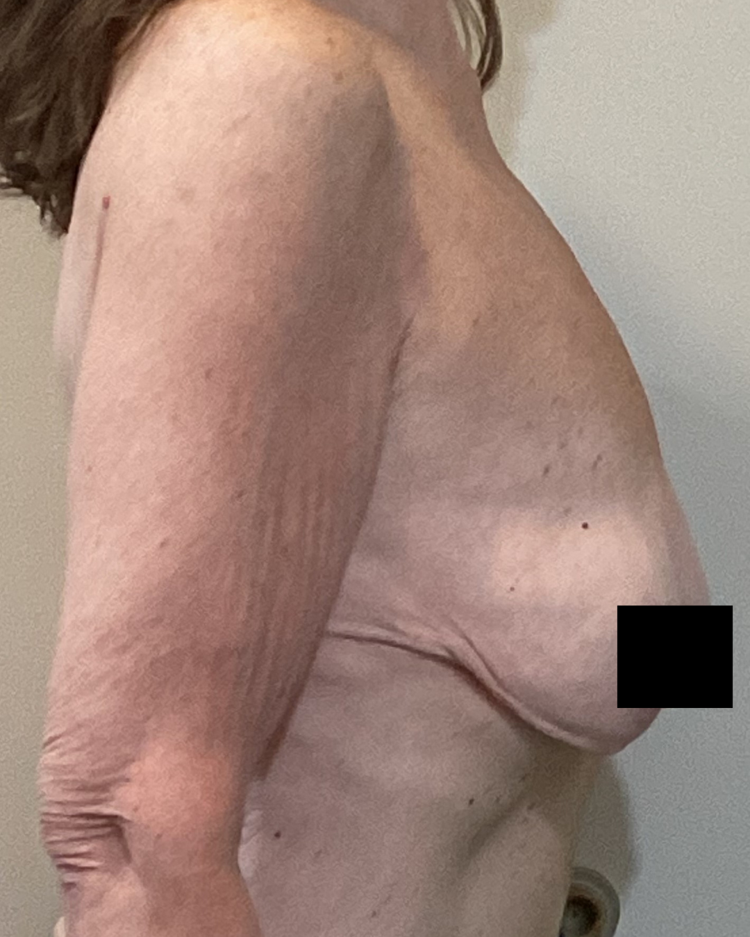 Breast Augmentations with Mastopexy before