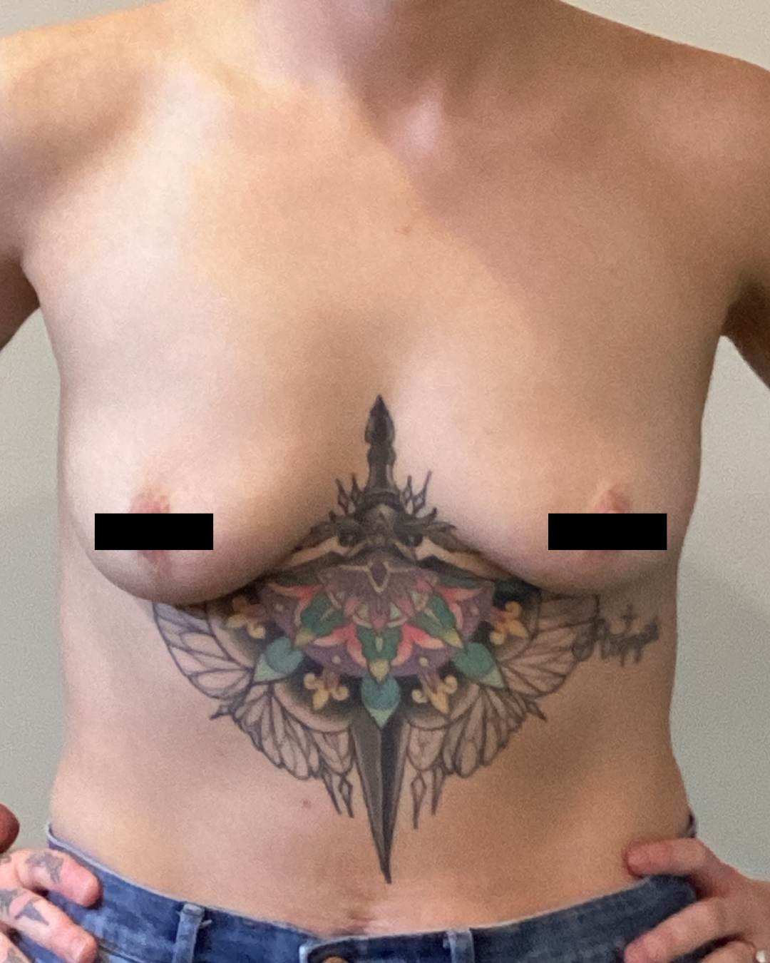 Breast Augmentation before