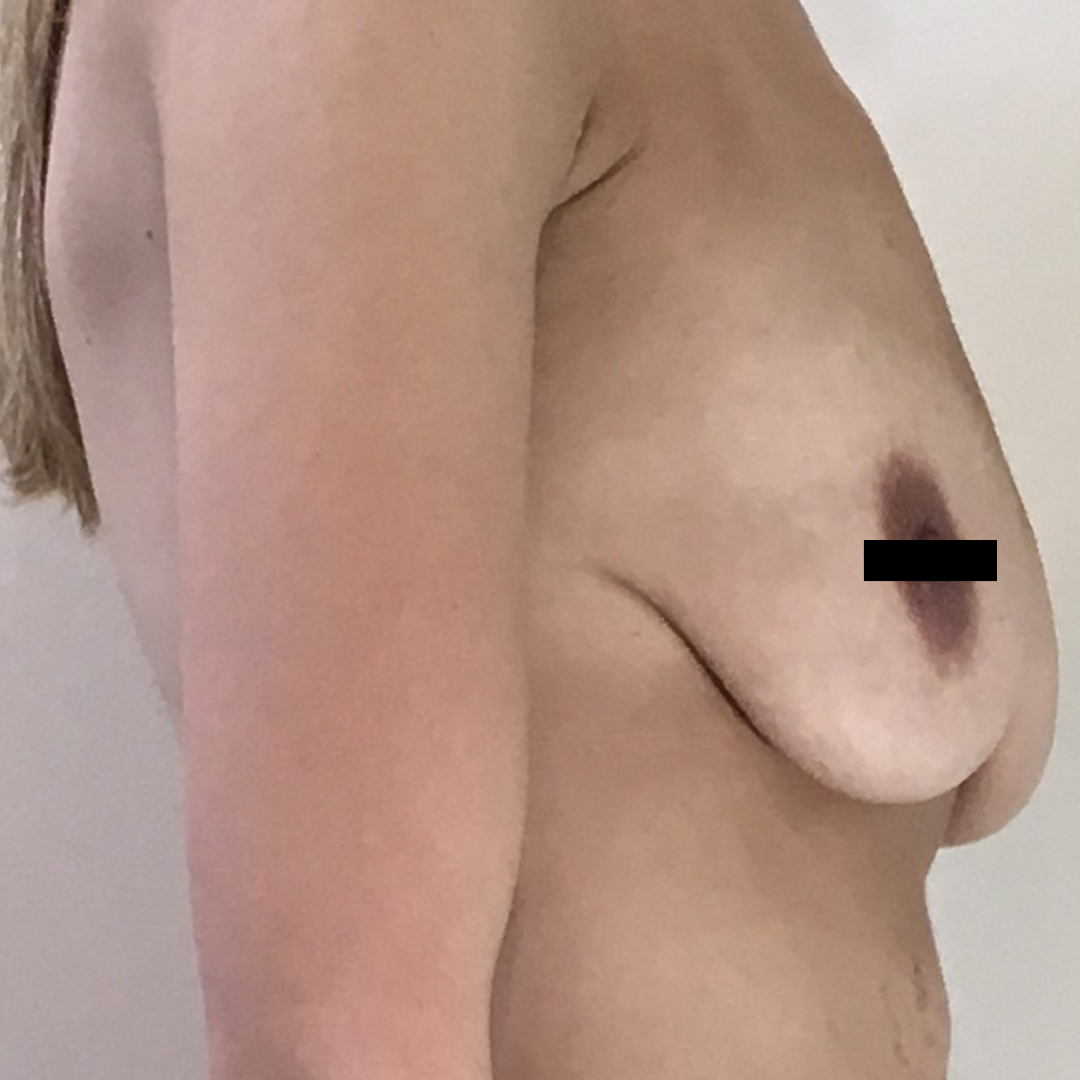 Breast Augmentation with Mastopexy before