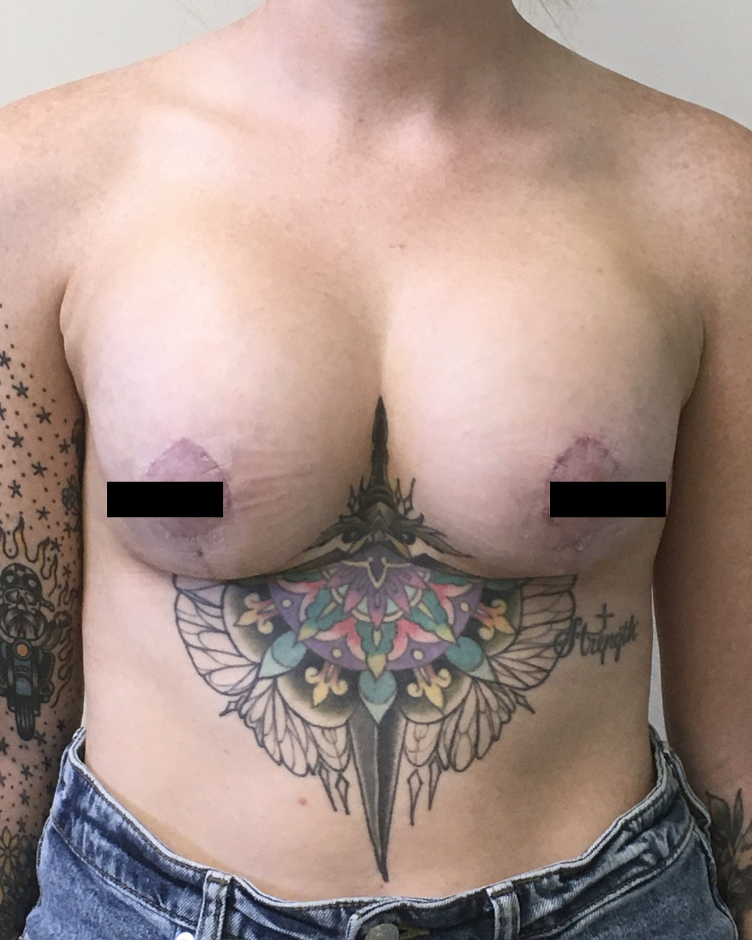 Breast Augmentation after