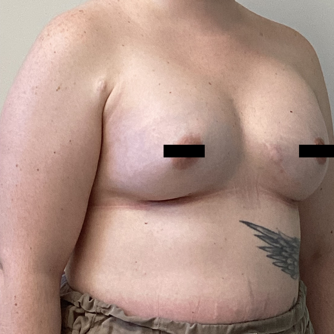 Breast Augmentation with Mastopexy after