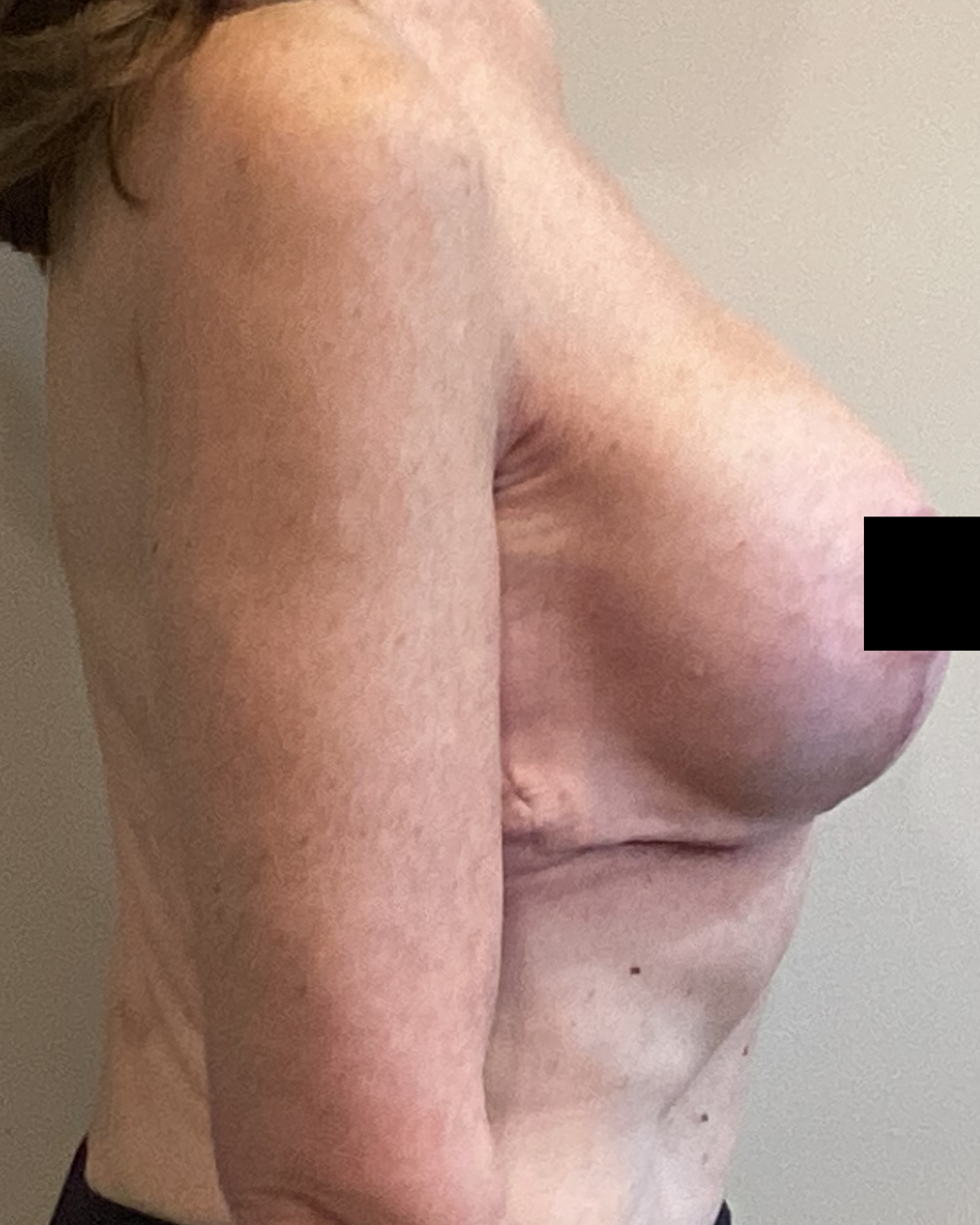 Breast Augmentations with Mastopexy after