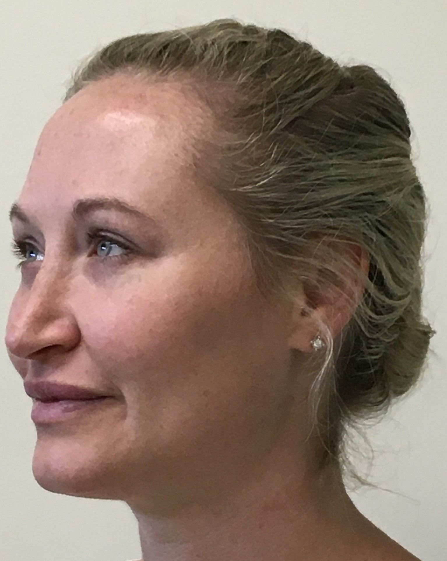 Rhinoplasty,  Lower Blepharoplasty, and Facial Fat Transfer after